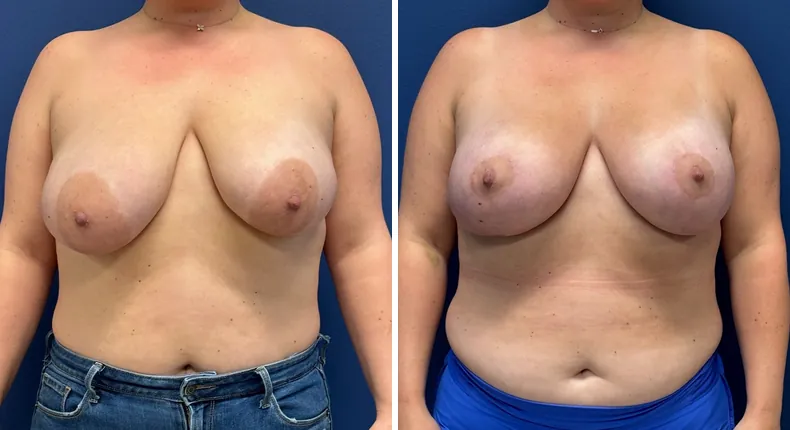 Before and after breast augmentation with lift: patient's breasts from the front