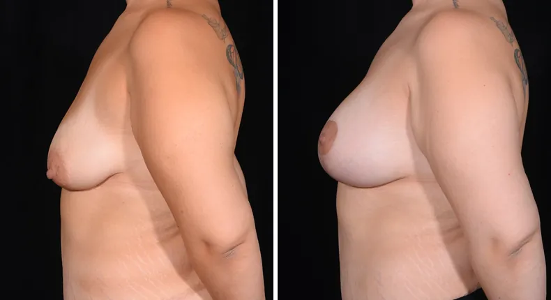 Before and after breast augmentation with lift: woman's breasts from the left side