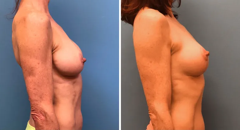 Before and after breast augmentation with lift: patient's breasts from the right side
