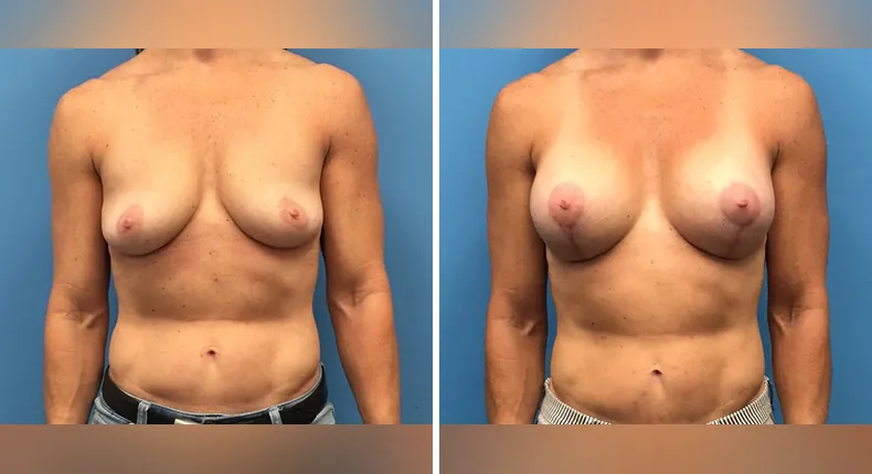Before and after breast augmentation with lift: patient's breasts from the front