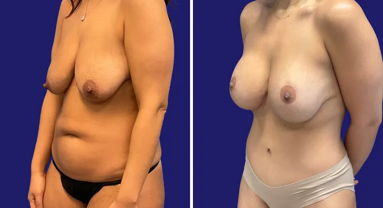 Before and after breast augmentation with lift: woman's breasts, with breast augmentation, breast lift, liposuction, tummy tuck and mommy makeover