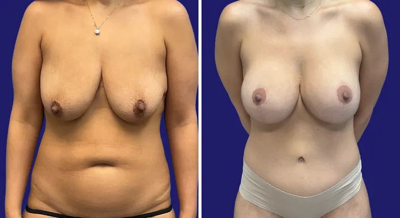 Before and after breast augmentation with lift: woman's breasts, with breast augmentation, breast lift, liposuction, tummy tuck and mommy makeover