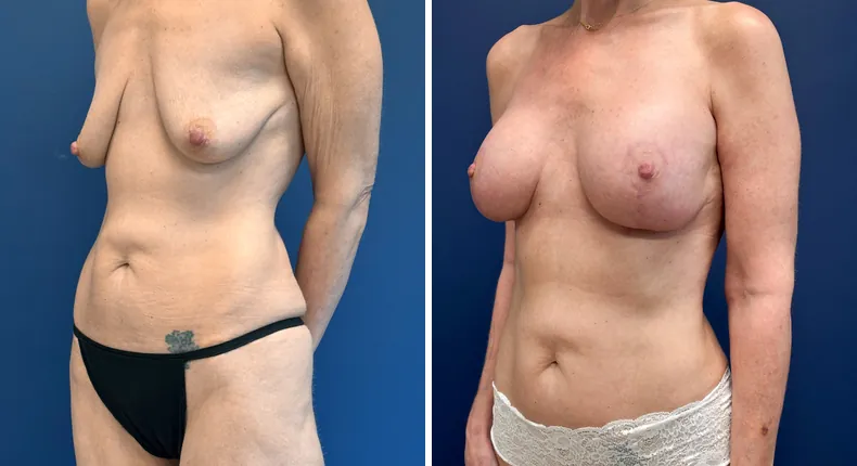 Before and after breast augmentation with lift: patient's breasts from the left side