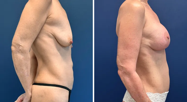 Before and after breast augmentation with lift: patient's breasts in right profile