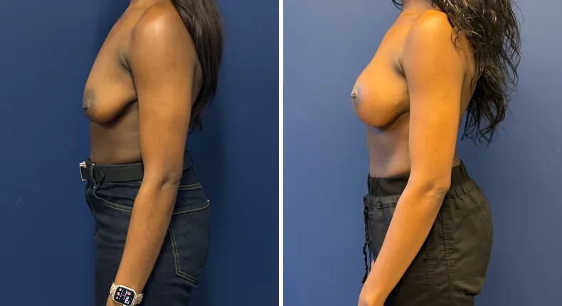 Before and after breast augmentation with lift: woman's breasts, with preserve breast augmentation