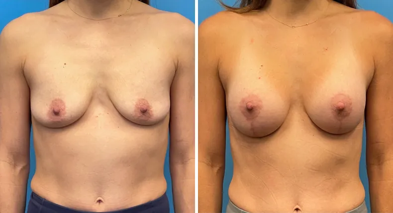 Before and after breast augmentation with lift: patient's breasts from the front