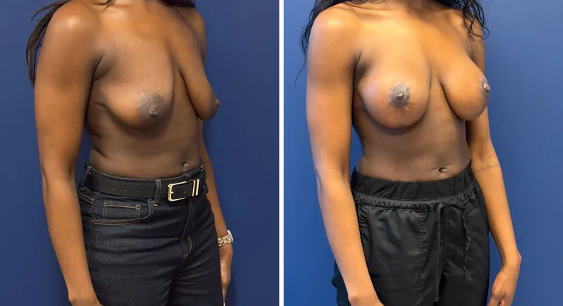 Before and after breast augmentation with lift: woman's breasts, with preserve breast augmentation