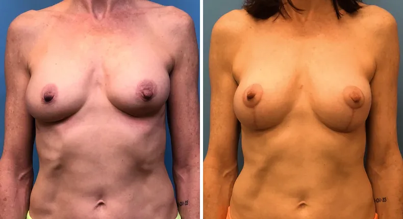 Before and after breast augmentation with lift: patient's breasts