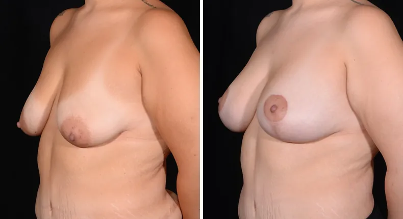 Before and after breast augmentation with lift: woman's breasts at a left angle