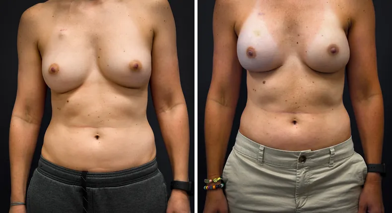 Before and after breast augmentation with lift: patient's breasts