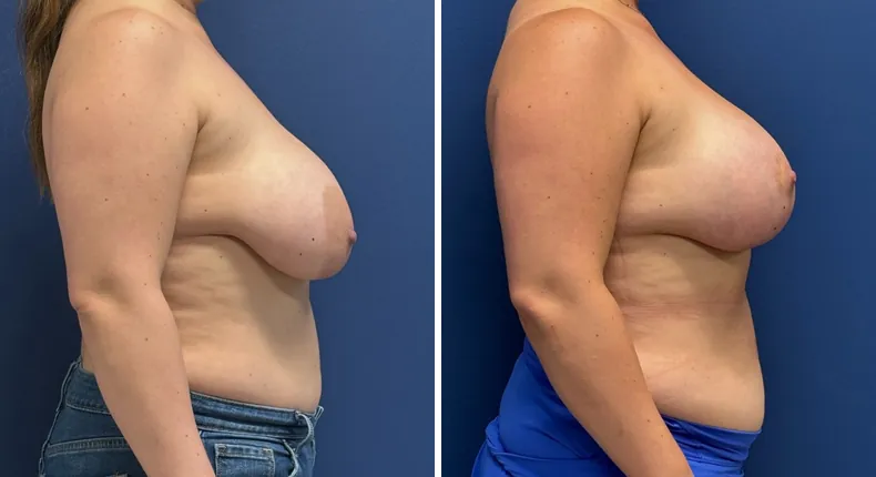 Before and after breast augmentation with lift: patient's breasts from the right side