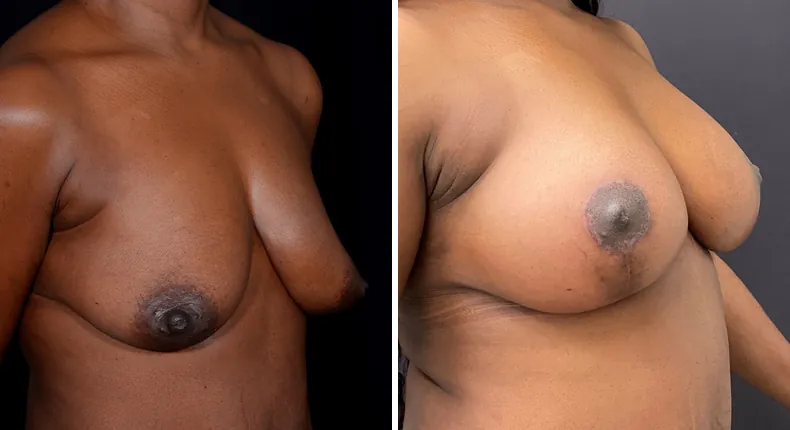 Before and after breast augmentation with lift: patient's breasts at a right angle