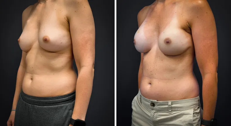 Before and after breast augmentation with lift: patient's breasts at a left angle