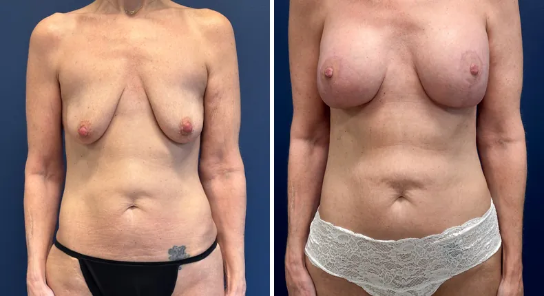Before and after breast augmentation with lift: patient's breasts