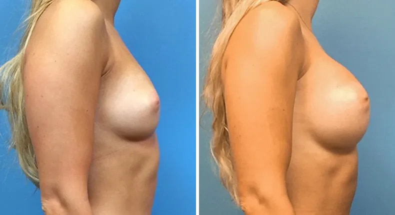 Before and after breast augmentation: woman's breasts from the right side