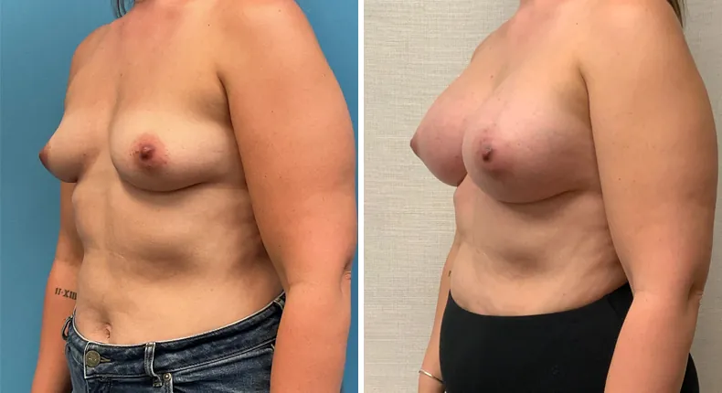 Before and after breast augmentation: woman's breasts at a left angle