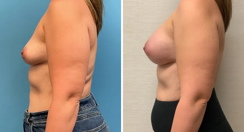 Before and after breast augmentation: woman's breasts from the left side