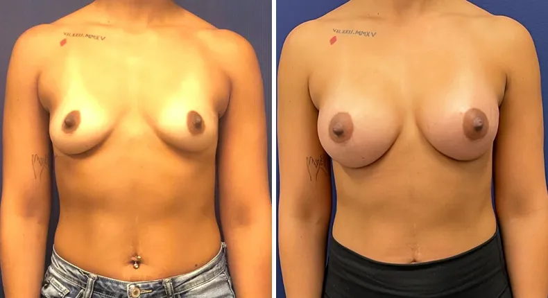Before and after breast augmentation: patient's breasts from the front