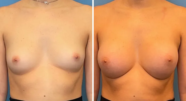 Before and after breast augmentation: patient's breasts from the front