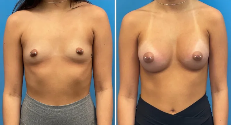 Before and after breast augmentation: patient's breasts from the front