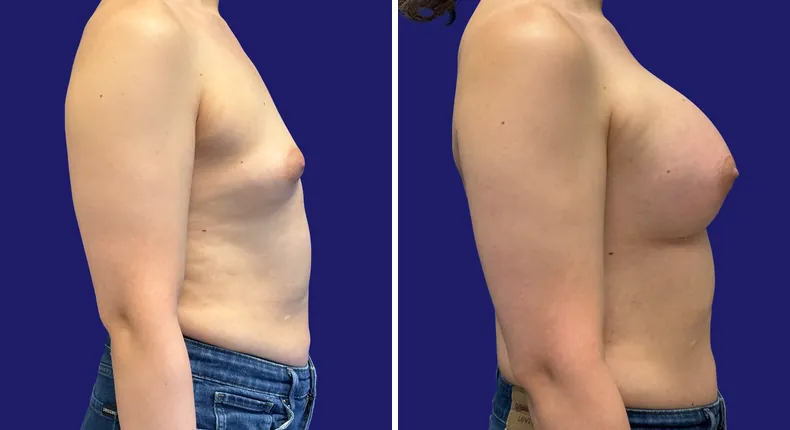 Before and after breast augmentation: woman's breasts