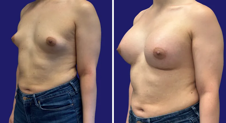 Before and after breast augmentation: woman's breasts
