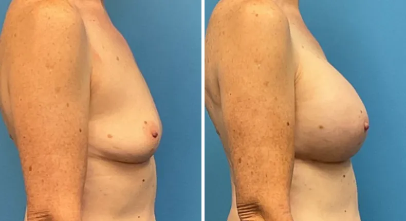 Before and after breast augmentation: woman's breasts from the right side