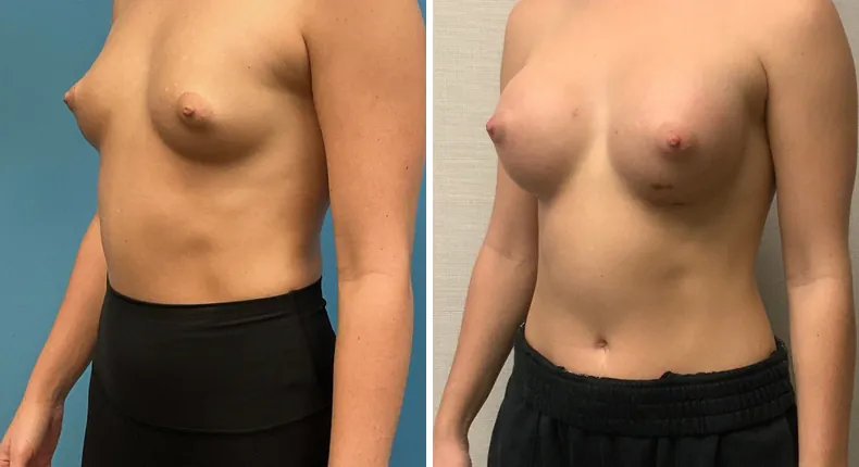 Before and after breast augmentation: patient's breasts at a left angle