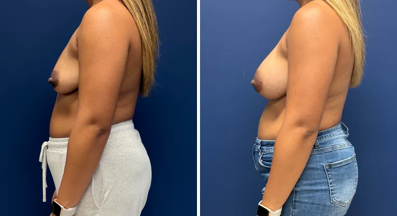 Before and after breast augmentation: woman's breasts