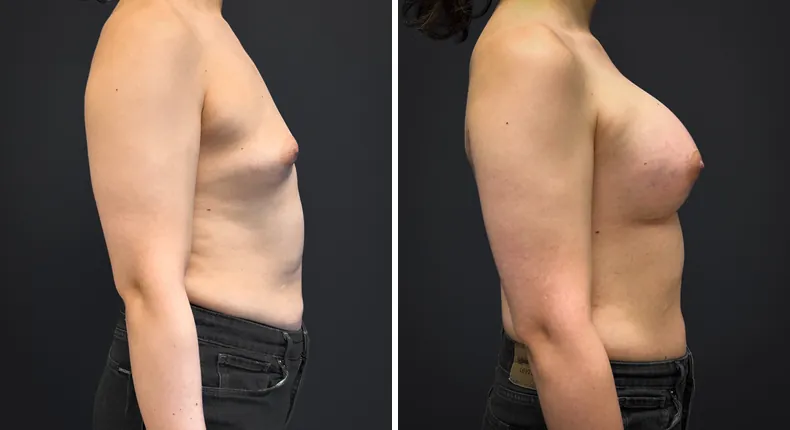 Before and after breast augmentation: patient's breasts from the right side