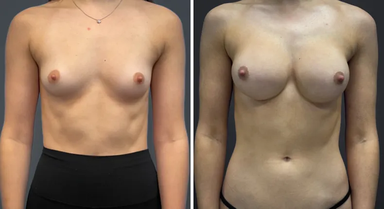 Before and after breast augmentation: patient's breasts from the front