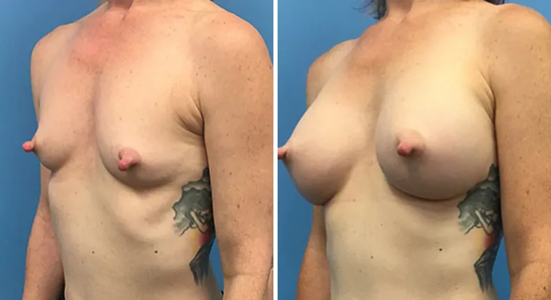 Before and after breast augmentation: woman's breasts at a left angle