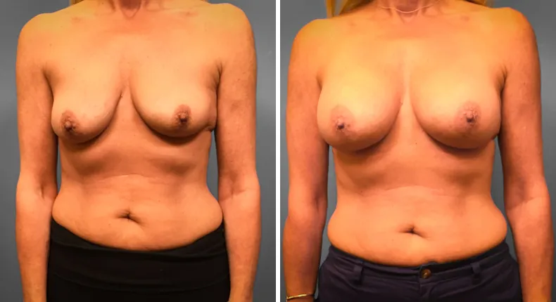Before and after breast augmentation: woman's breasts from the front