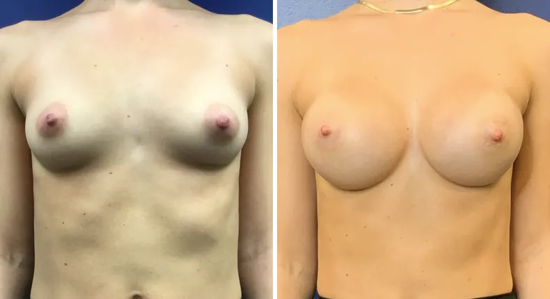 Before and after breast augmentation: woman's breasts from the front