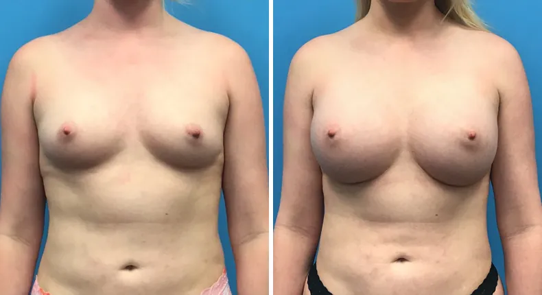 Before and after breast augmentation: patient's breasts from the front