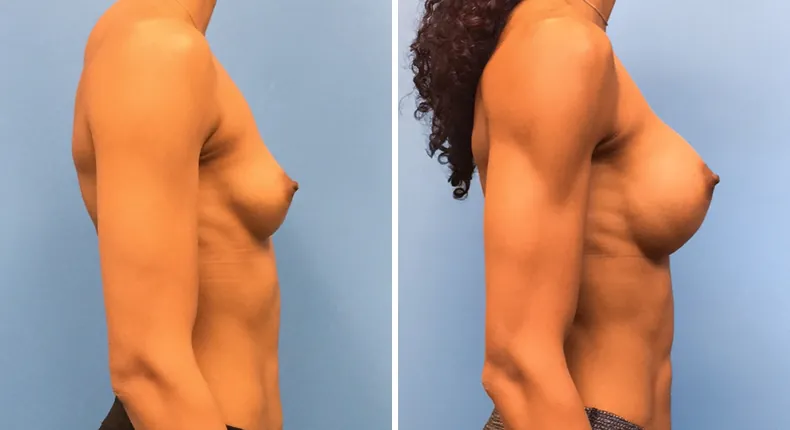 Before and after breast augmentation: patient's breasts from the right side