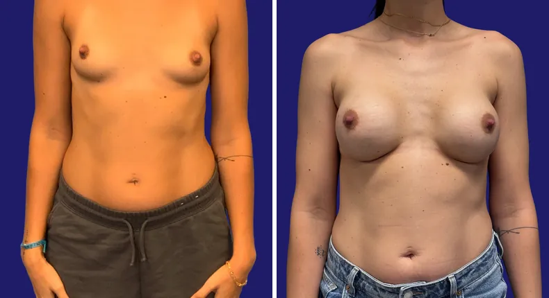 Before and after breast augmentation: woman's breasts from the front