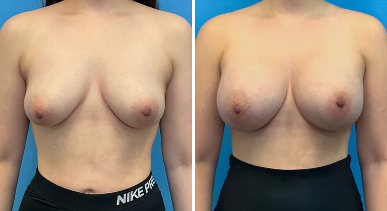 Before and after breast augmentation: patient's breasts from the front