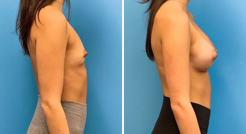 Before and after breast augmentation: patient's breasts from the right side