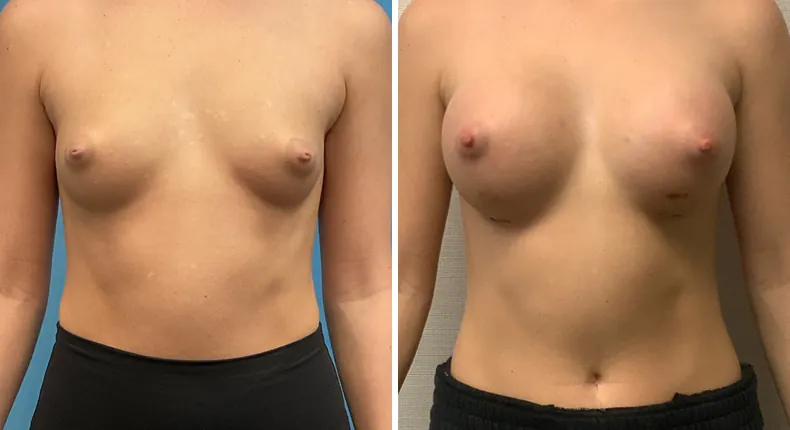 Before and after breast augmentation: patient's breasts from the front