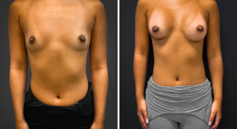 Before and after breast augmentation: patient's breasts from the front