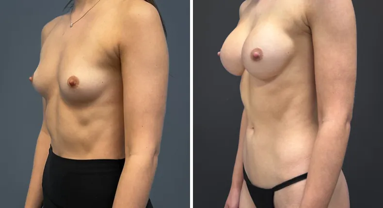 Before and after breast augmentation: patient's breasts at a left angle