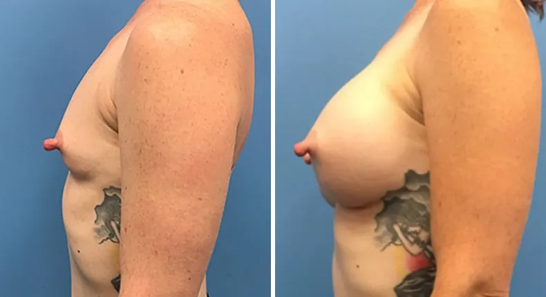 Before and after breast augmentation: woman's breasts from the left side