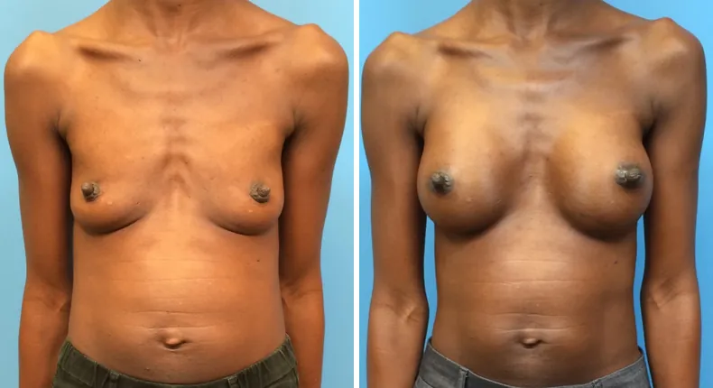 Before and after breast augmentation: woman's breasts from the front