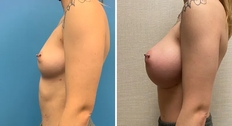 Before and after breast augmentation: patient's breasts from the left side