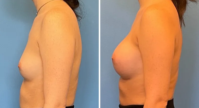 Before and after breast augmentation: patient's breasts from the left side