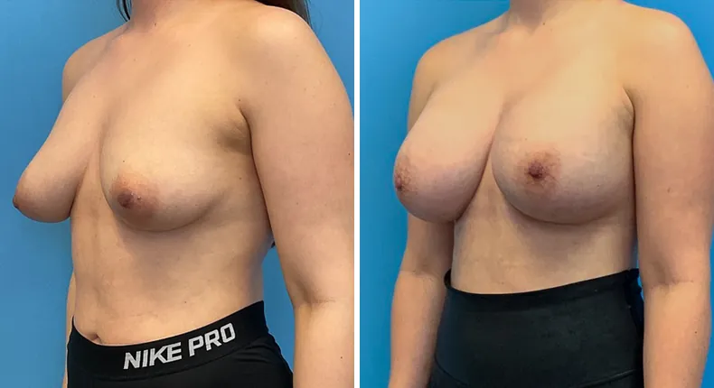 Before and after breast augmentation: patient's breasts at a left angle