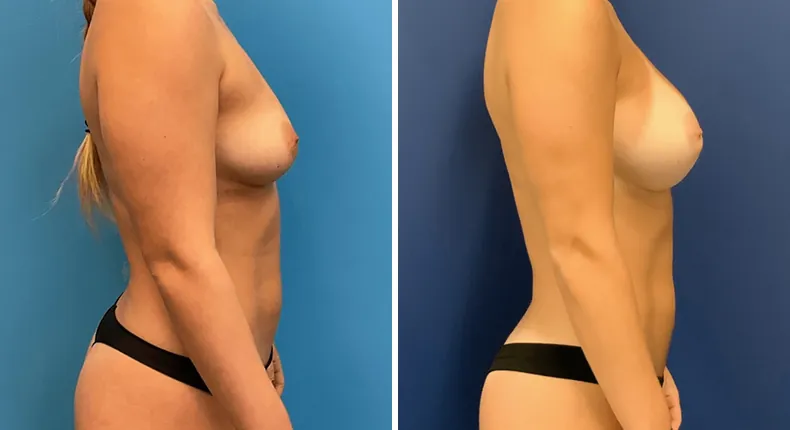Before and after breast augmentation: patient's breasts in right profile