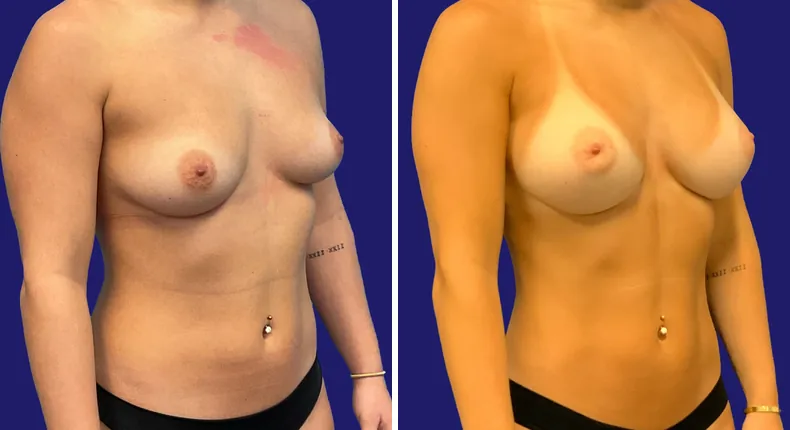 Before and after breast augmentation: woman's breasts, with liposuction and mommy makeover