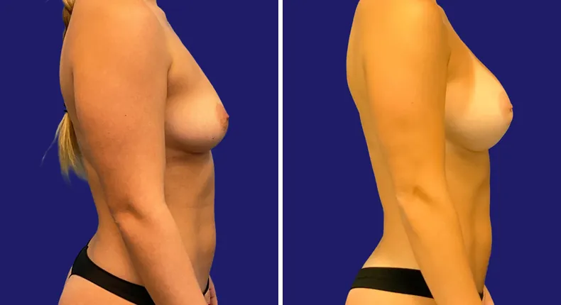 Before and after breast augmentation: woman's breasts, with liposuction and mommy makeover